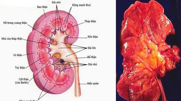 Viêm cầu thận cấp thuộc phạm vi chứng phù thũng (thể dương thủy) của y học cổ truyền.